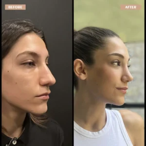 Primary Rhinoplasty Before & After