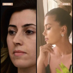 Primary Rhinoplasty Before & After
