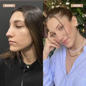 Primary Rhinoplasty Before & After