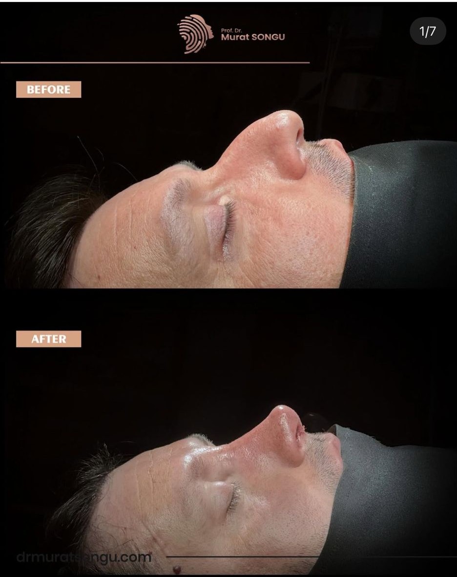 Nose Types - Nose Shapes roman nose rhinoplasty before and after