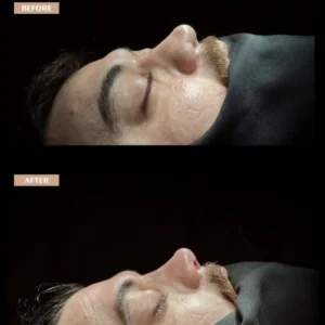 Revision Rhinoplasty Before & After