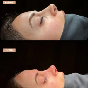 Revision Rhinoplasty Before & After