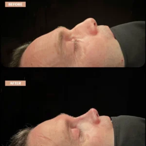 Revision Rhinoplasty Before & After