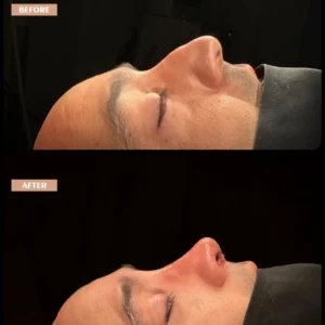 Revision Rhinoplasty Before & After