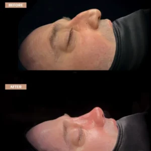Revision Rhinoplasty Before & After