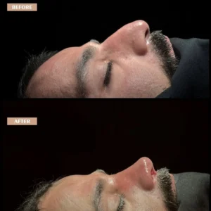 Revision Rhinoplasty Before & After