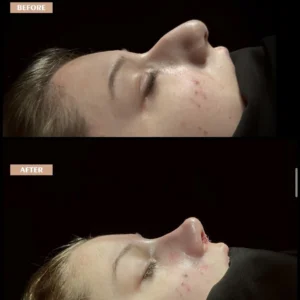 Revision Rhinoplasty Before & After