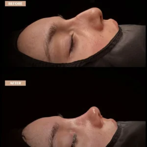 Revision Rhinoplasty Before & After
