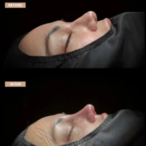 Revision Rhinoplasty Before & After