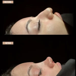 Revision Rhinoplasty Before & After