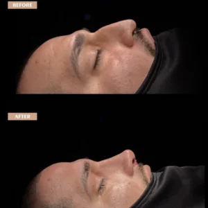 Revision Rhinoplasty Before & After