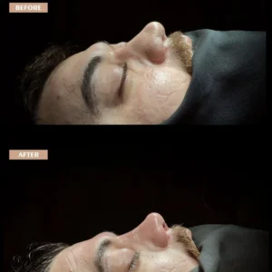 Revision Rhinoplasty Before & After