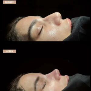 Revision Rhinoplasty Before & After