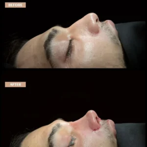 Revision Rhinoplasty Before & After