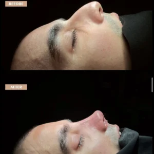 Revision Rhinoplasty Before & After