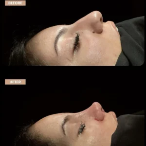 Revision Rhinoplasty Before & After