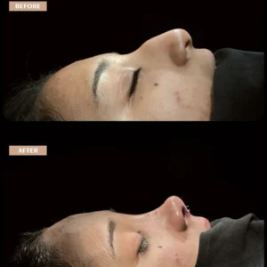 Revision Rhinoplasty Before & After