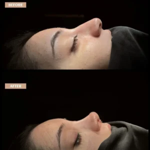 Revision Rhinoplasty Before & After