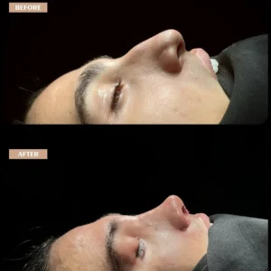 Revision Rhinoplasty Before & After