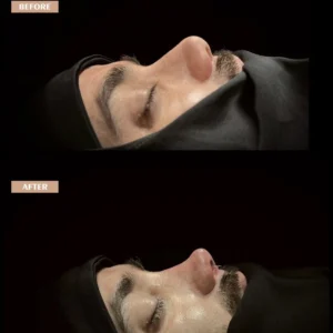 Revision Rhinoplasty Before & After