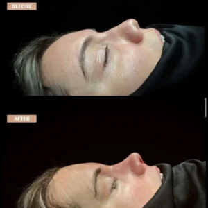 Revision Rhinoplasty Before & After