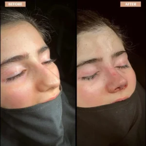 Revision Rhinoplasty Before & After