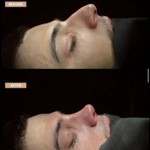 Revision Rhinoplasty Before & After