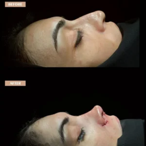 Revision Rhinoplasty Before & After