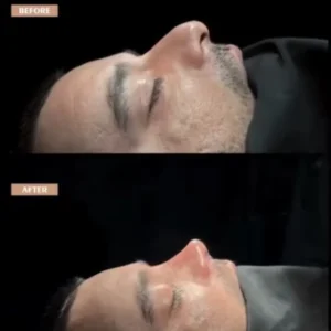 Revision Rhinoplasty Before & After
