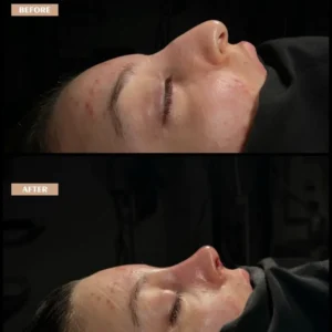 Revision Rhinoplasty Before & After