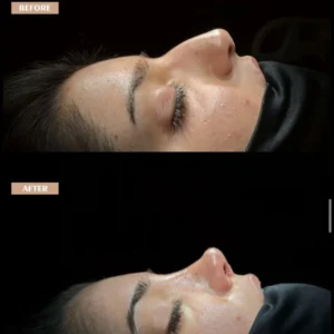Revision Rhinoplasty Before & After