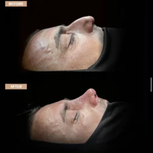 Revision Rhinoplasty Before & After