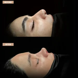 Revision Rhinoplasty Before & After