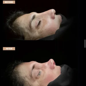 Revision Rhinoplasty Before & After