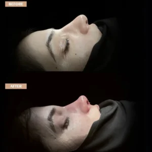 Revision Rhinoplasty Before & After