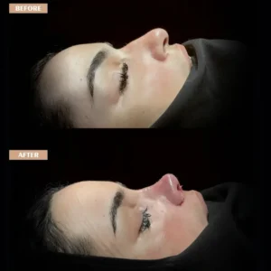 Revision Rhinoplasty Before & After