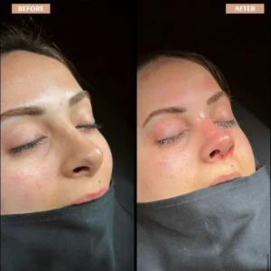 Revision Rhinoplasty Before & After