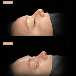 Revision Rhinoplasty Before & After