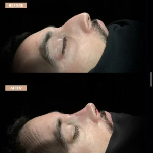Revision Rhinoplasty Before & After