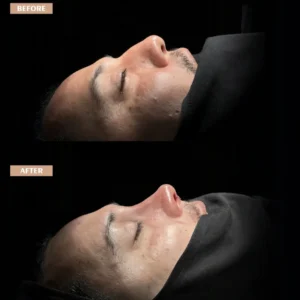 Revision Rhinoplasty Before & After