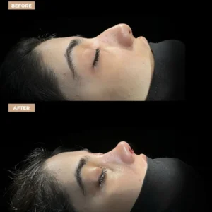 Revision Rhinoplasty Before & After