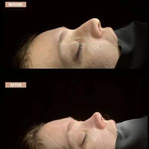 Revision Rhinoplasty Before & After