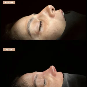 Revision Rhinoplasty Before & After