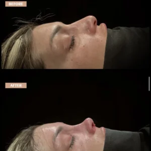 Revision Rhinoplasty Before & After