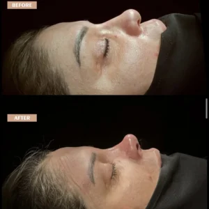 Revision Rhinoplasty Before & After