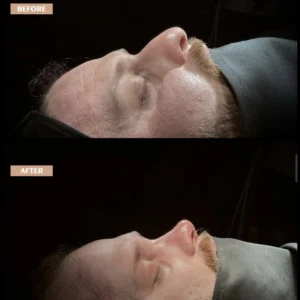 Revision Rhinoplasty Before & After