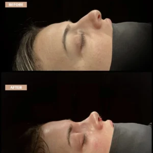 Revision Rhinoplasty Before & After