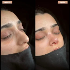 Revision Rhinoplasty Before & After