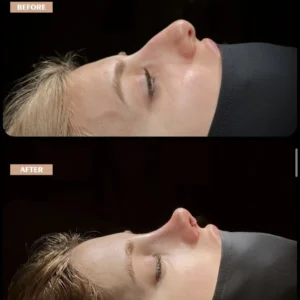 Revision Rhinoplasty Before & After