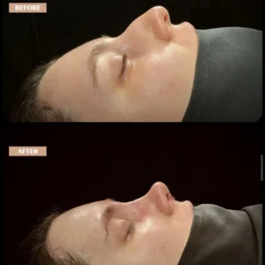 Revision Rhinoplasty Before & After